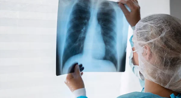 Lung Cancer Screening and Prevention